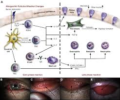 It was part of the em spectrum show that i have uploaded on the link above. The Spectrum Of Allergic Ocular Diseases Annals Of Allergy Asthma Immunology