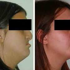 Paciente n.° 1: fisura labio palatina bilateral completa. Izquierda:...