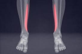 Running mechanics for clinicians online course: Prone To Shin Splints Mit Medical