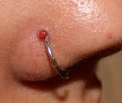 Sorry i haven't posted i'm gonna. Swollen Nose Piercing Causes Treatment Authoritytattoo