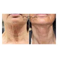 We spend quality time with each patient, evaluating and customizing procedures to enlighten the most stunning outcome. Nova Clinic Spa Novaclinicuk Twitter