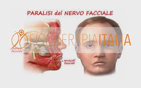 La paralisi facciale (paralisi facciale) è una debolezza o paralisi dei muscoli facciali, che di solito può interessare una o, più raramente, entrambe le metà del viso. La Paralisi Di Bell Cause Segni Clinici E Cure