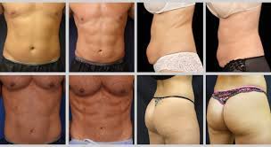 You can expect to keep your results for six months to a year, but it is recommended that you keep these results up with a healthy lifestyle of diet and exercise. Emsculpt Manhattan Muscle Sculpting New York City Manhattan Aesthetics