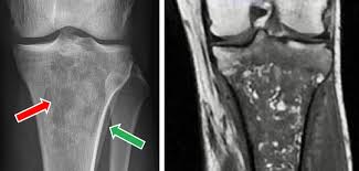 Image result for Osteomyelitis XRay