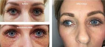 Training with no pen purchase is £500 net per person. Plasma Fibroblasting