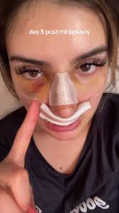 Rhinoplasty Recovery Update: Day 5 Post Surgery