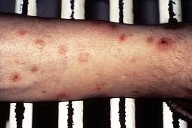 Image result for Leukemia