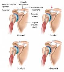 Image result for Rotator Cuff Rupture