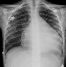 X Rays Of The Chest Heart And Blood Vessel Disorders Merck Manuals Consumer Version Add a gift receipt with prices hidden. x rays of the chest heart and blood