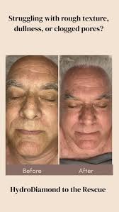 HydroDiamond is a favorite in my treatment room—especially for my client  Steve, who’s been with me for about two years., When Steve first came in,  his main concerns were congested pores, rough skin ...