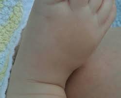 Mehr als 5 flecken > 25 mm macht einen m. Cafe Au Lait Fleck Und Andere Merkmale Januar 2015 Babyclub Babycenter
