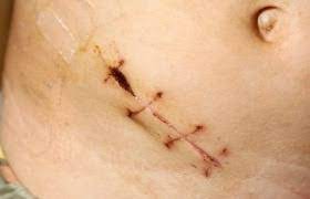 Symptomen, gevolgen, operatie, postoperatieve periode. Ontstoken Appendix Mag Vaker Blijven Zitten Medzine App