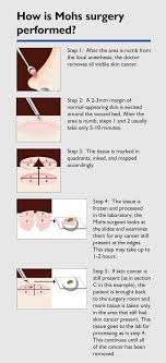 Skin cancer is the most common type of cancer in the u.s. Mohs Surgery Skin Cancer Treatment Dallas Skin Cancer Surgeons Texas