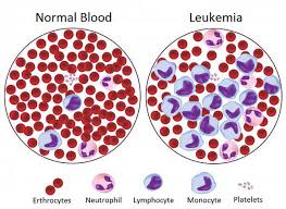 Instead of having a tumor in one organ growing larger and larger, and then spreading to other tissues, in leukemia cancer starts in the stem cells that will ultimately become blood cells. Blood Cancer World Fights Back