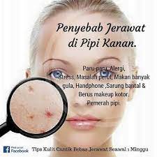 1 jerawat di pipi kanan dan 1 jerawat di pipi kiri. Azlin S Beauty Punca Jerawat Facebook