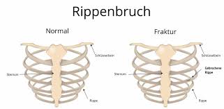 Rippenbruch Rippenfraktur Rippenserienfraktur