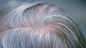 Vitiligo occurs when cells that produce melanin die or stop functioning, resulting in a loss of skin color in patches over the body that usually grow over time. Grey Hair Gene Discovered By Scientists Bbc News