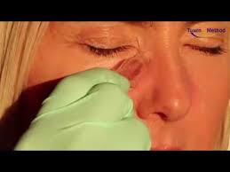 How To Treat Blocked Tear Ducts With Cupping Vacuum Pressure Youtube In 2020 Blocked Tear Duct Massage Therapy Techniques Decompression Therapy