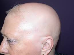 Research suggests there may be a genetic component linked to developing alopecia totalis; Alopecia Areata Deximed