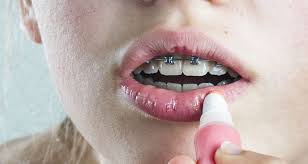 La Pasta De Dientes Que Usas Podria Ser La Causante De Tus Labios Agrietados Upsocl