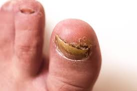 Image result for Onychogryphosis feet