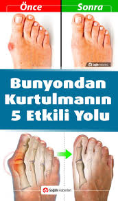 Bunyon Nedir Bunyonlardan Kurtulmanin Etkili Yolu Video Saglik Saglikli Yasam Tarzi Halluks Valgus