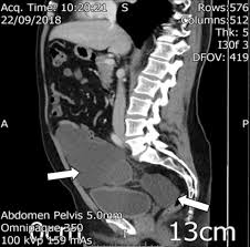 Benign peritoneal cystic mesothelioma (bpcm) is a rare disease entity that arises from mesothelioma cells. Benign Multicystic Peritoneal Mesothelioma Presenting As Appendiceal Abscess A Diagnostic And Therapeutic Challenge Seretis Gastroenterology Research