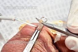 Image result for Vasectomy