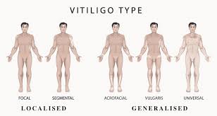 Image result for Vitiligo