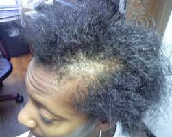 Some of these styles have also been chosen because they will allow you to use little styling tricks to make your hair look thicker and more voluminous. Afro American Hair Loss Fue Hair Transplant Clinics