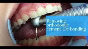 It can 16months to 30 months. How To Remove Braces Glue Braces Explained