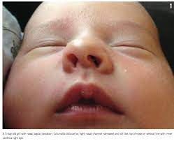 A Neonate With A Crooked Nose Consultant360