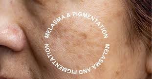 Image result for Melasma