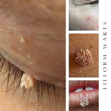 Image result for verrucae filiformes