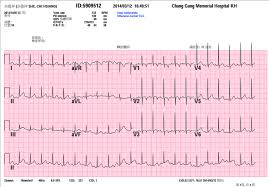 Electrocardiogram Ecg With Normal Sinus Rhythm After 3