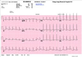 electrocardiogram ecg with normal sinus rhythm after 3