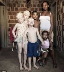 5 year old awakens with abdominal pain,dizziness,cool and. Albinism Is Beautiful Black Mother Human Albinism