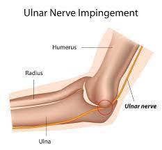 Posterior interosseous nerve palsy is rarely caused by synovitis of the elbow in patients with ra (ogawa et al., 2007). Ulnar Neuropathy Can Be Treated By The Experts At Premier Neurology
