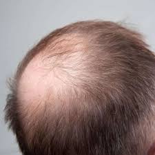 Seine haut ist karottenfarben und ledrig, die haare sehen aus wie softeis mit zitronengeschmack. Haartransplantationen Fullen Lichte Lucken Auf Stars