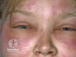 Image result for Anaphylaxis