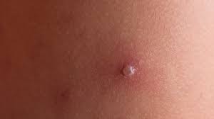 Herpes virus, který je způsobuje Plane Nestovice V Tehotenstvi Hrozi Riziko Nenarozenemu Miminku Jenprotehotne Cz