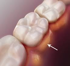 These must be treated before boils will go away. How To Get Rid Of An Abscess On Your Gum Quora