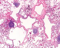 Granulomatous interstitial pneumonitis in association with primary. Developmental And Pediatric Lung Disease Sciencedirect