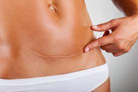 4 Raisons De Faire De La Réadaptation Après Une Césarienne – Physio  Pelvienne, Noémie Séguin Physiothérapeute