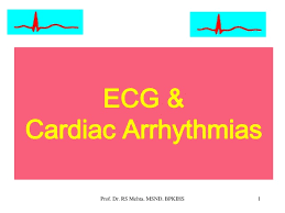 Ecg Arrhythmias