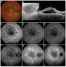 Ninety percent of cases occur in men. Pharmaceuticals Free Full Text Central Serous Chorioretinopathy Treatment With Laser Html