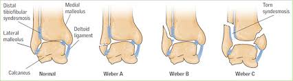 One option involves inserting screws that run from the front to the back of the ankle or the other way around. Assessment And Management Of Patients With Ankle Injuries