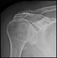 Image result for Shoulder Imaging