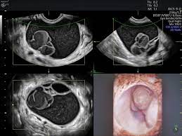 There was no fluid (ascites) seen on ultrasound. Simple Vs Complex Ovarian Cysts The Link To Ovarian Cancer Empowered Women S Health