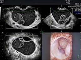 Clearly visible are cystic implants on the peritoneal reflection (red arrow). Simple Vs Complex Ovarian Cysts The Link To Ovarian Cancer Empowered Women S Health